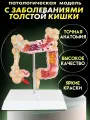 Анатомическая модель органов человека - 3Д макет с заболеваниями толстой кишки