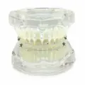 Челюсть стоматологическая, модель челюсти с керамическими брекетами, прозрачная