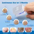 Аппарат для очистки ногтевой пластины Nail Fungus Cleaning Laser Device с дисплеем, от грибка ногтей, для ног, рук